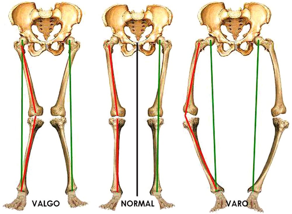 Osteotomy – Dr. Alberto Gobbi- O.A.S.I Medical Office | Dottor Alberto ...